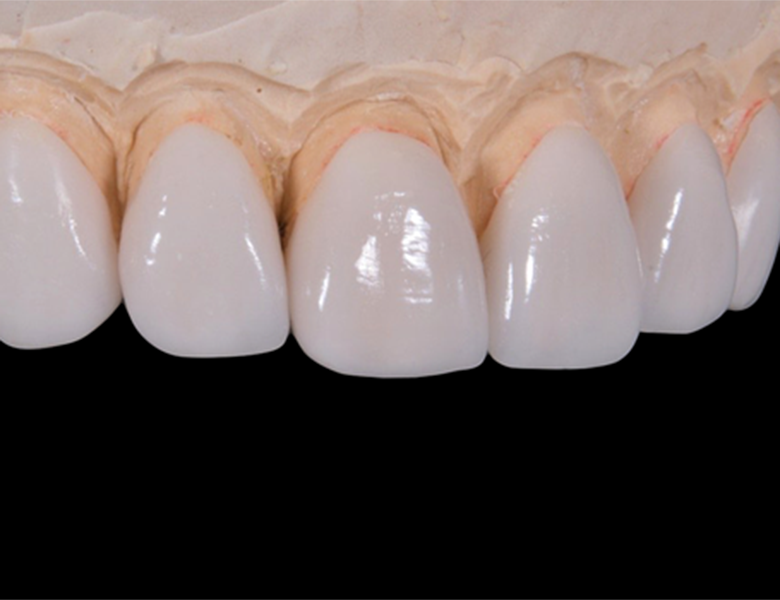 審美歯科（メタルフリー治療） - 東金の歯医者、山田歯科クリニック